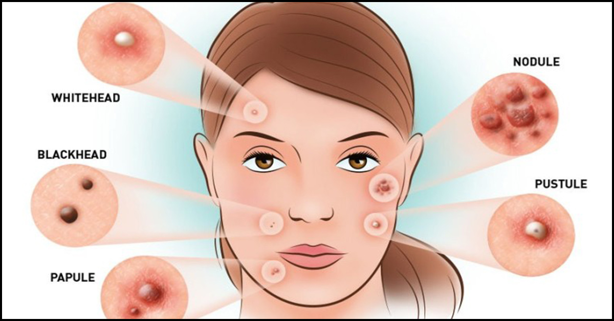 How do you prevent pimples? 15 ways to prevent pimples