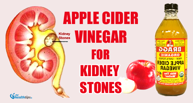 Can Apple Cider Vinegar Treat Kidney Stones?