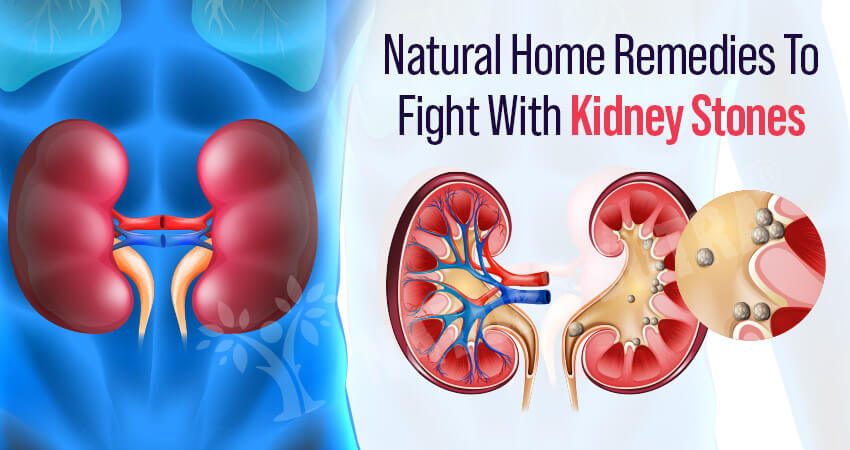 8 Natural Remedies to Fight Kidney Stones at Home
